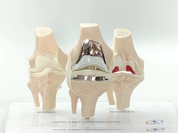 Knee Pathology Demonstration Models - 图片 2