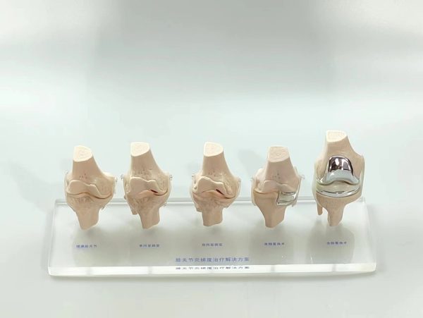 Knee Pathology Demonstration Models - 图片 3