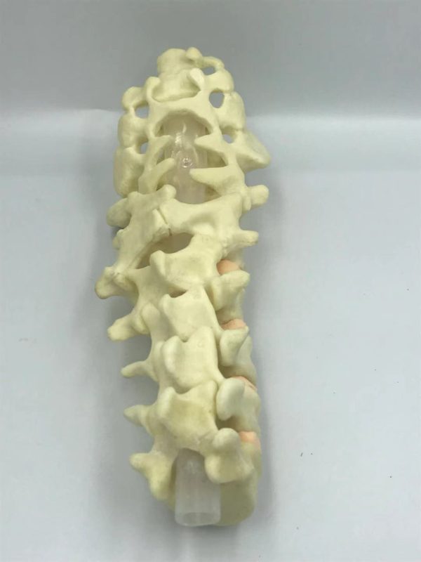Pediatric deformed lumbar spine