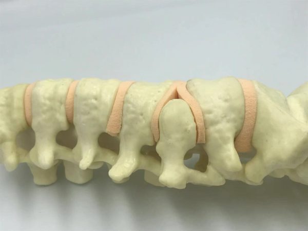 Pediatric deformed lumbar spine